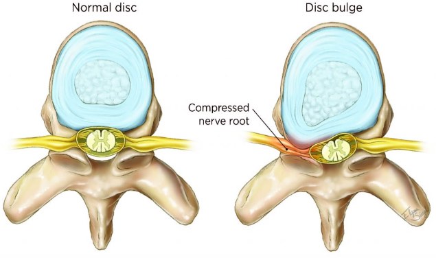 a normal disc compared to a bulging disc